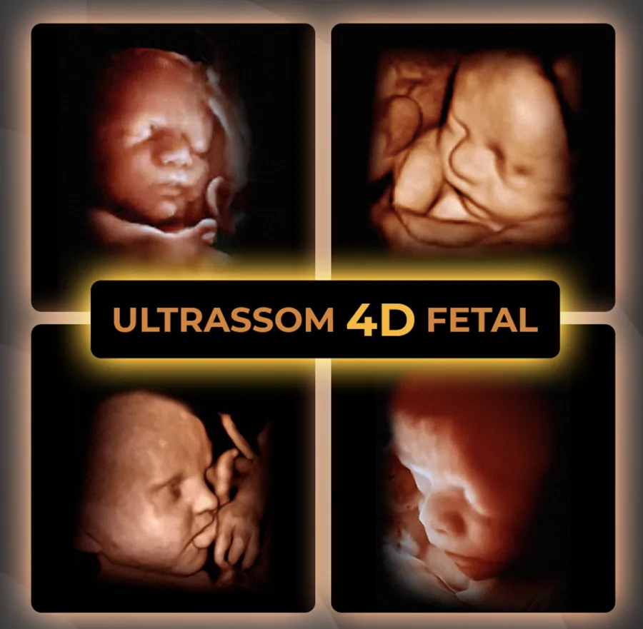 Imagens de ultrassom 4D fetal feitas na UltraCare